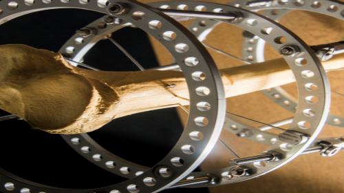 Innovation on the frontline: rebuilding bodies with ‘Bone Bricks’